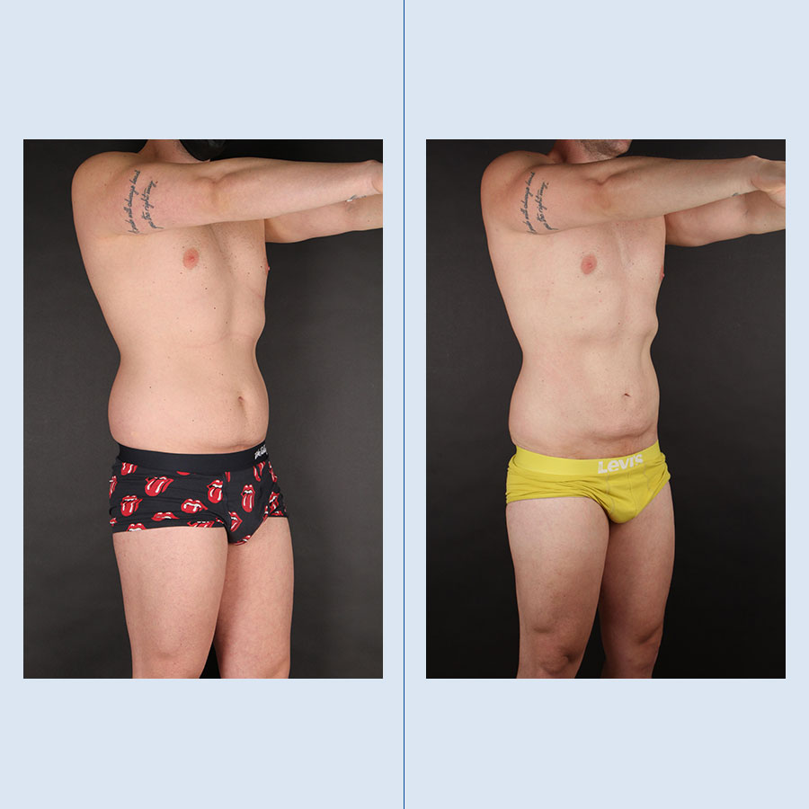 Antes y Después Lipo Vaser