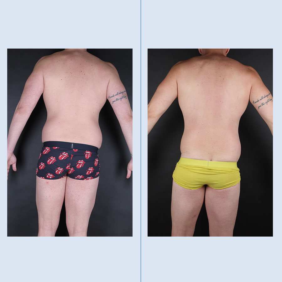 Antes y Después Lipo Vaser
