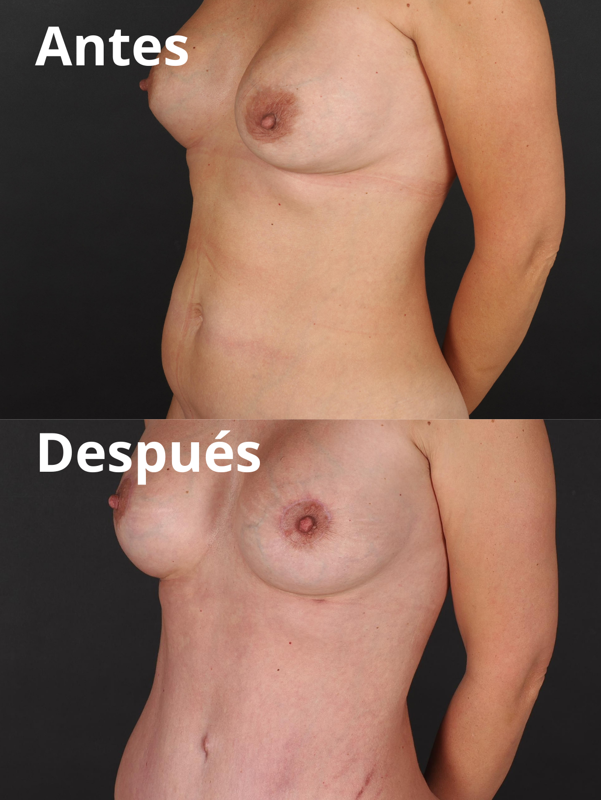 Mommy Makeover antes y después