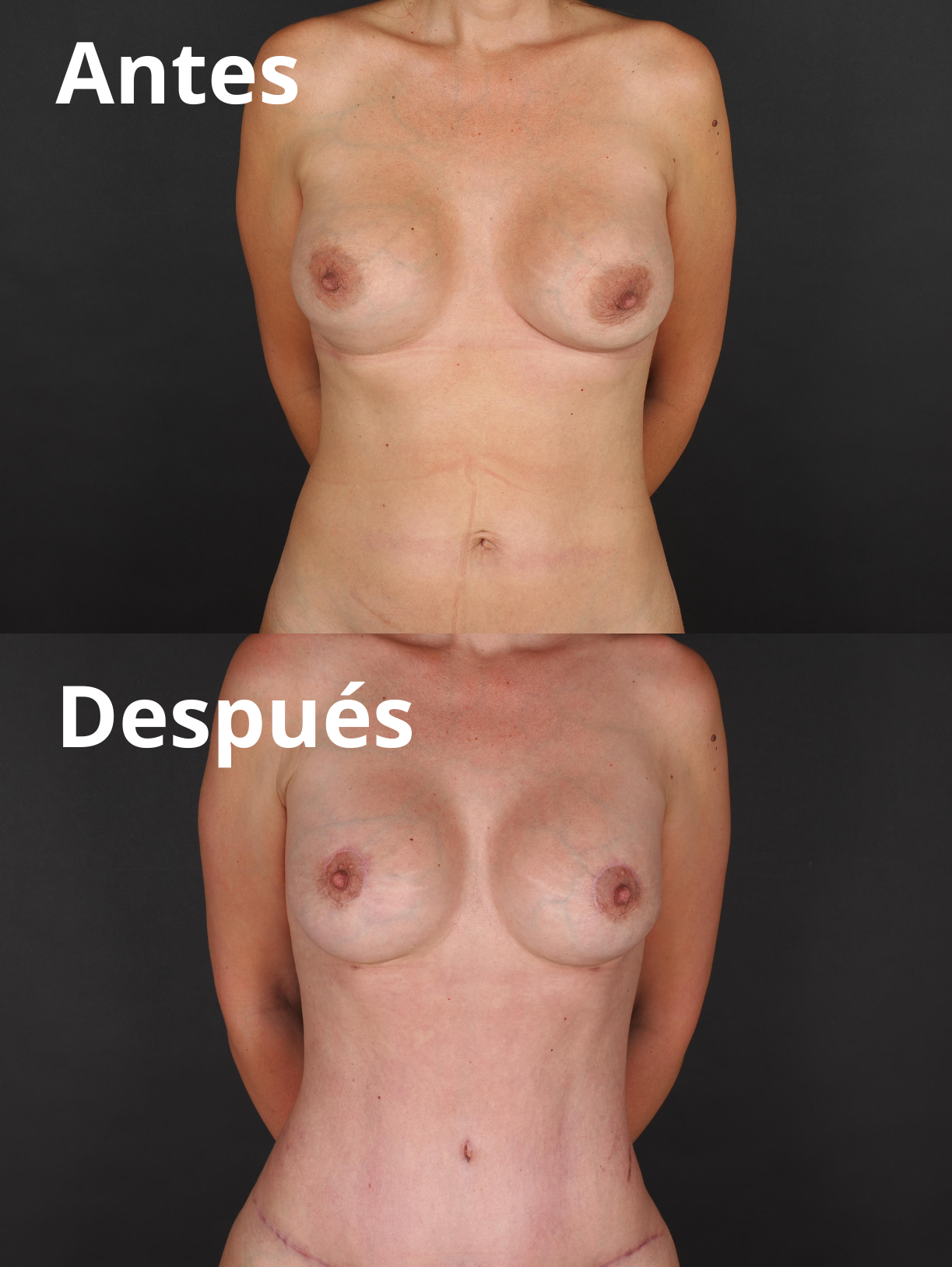 Mommy Makeover antes y después