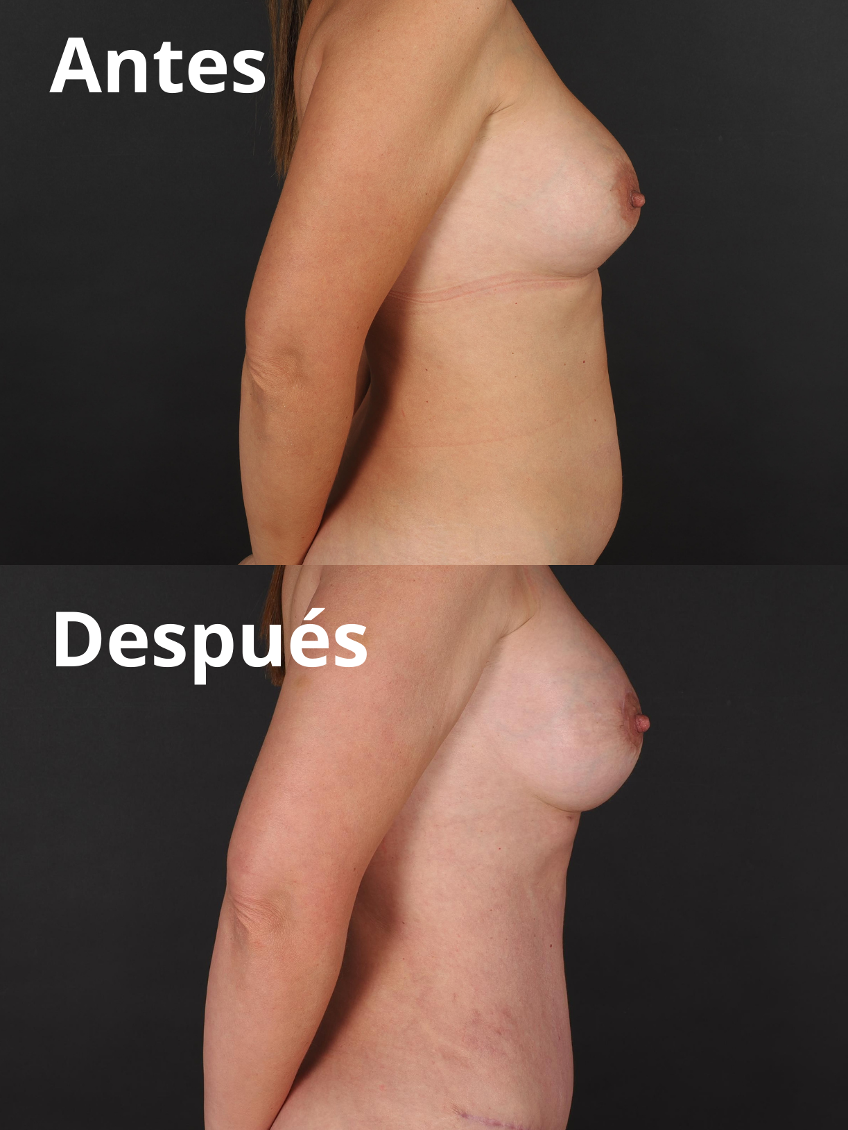 Mommy Makeover antes y después