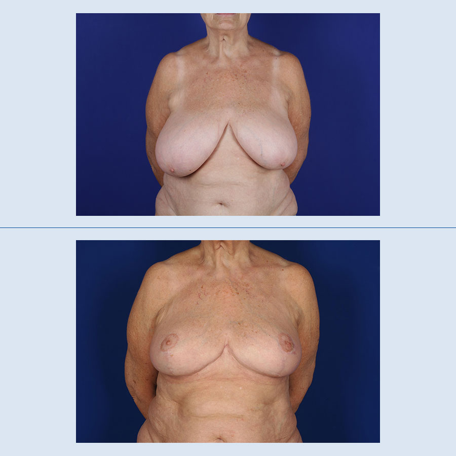 Antes y Después Breast Reduction