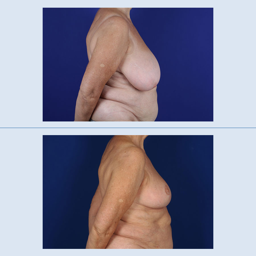 Antes y Después Breast Reduction