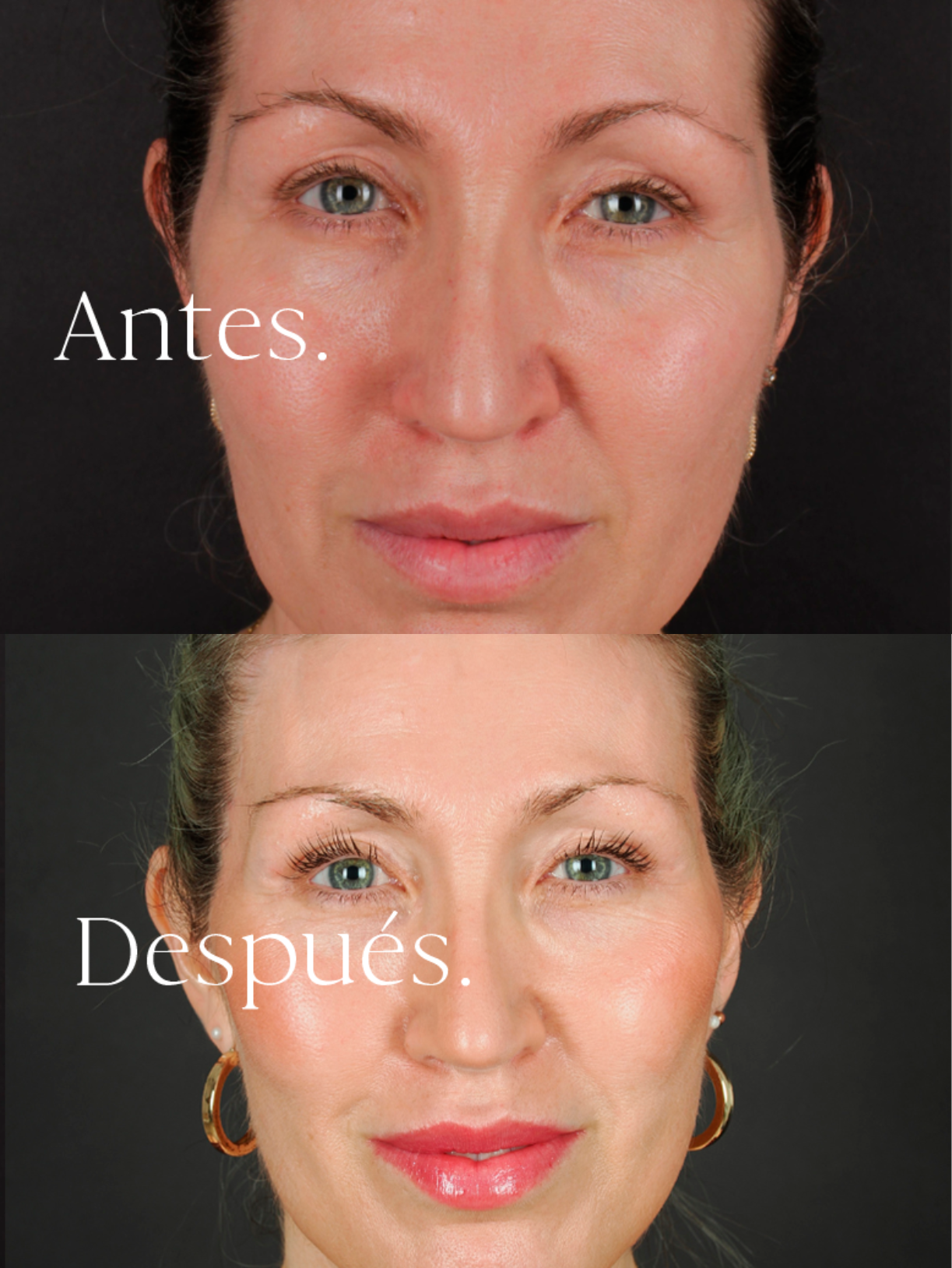 Lifting Facial antes y después