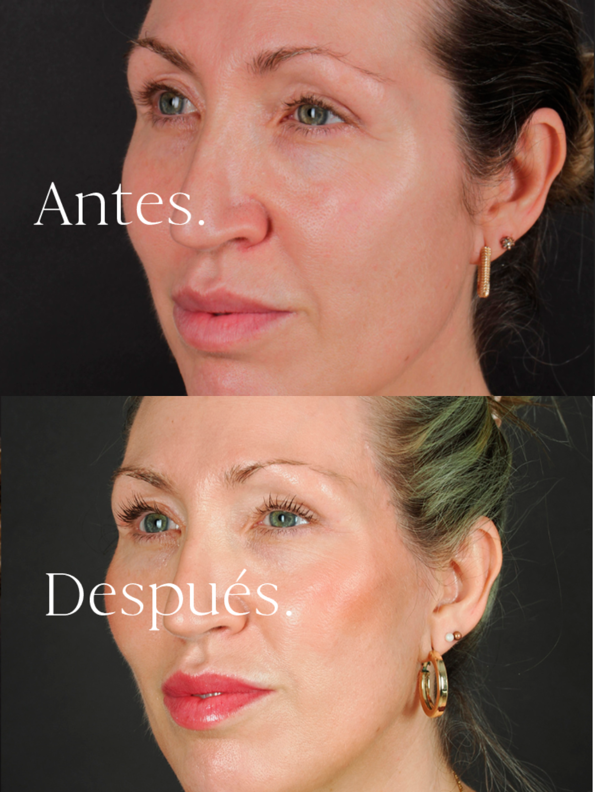 Lifting Facial antes y después