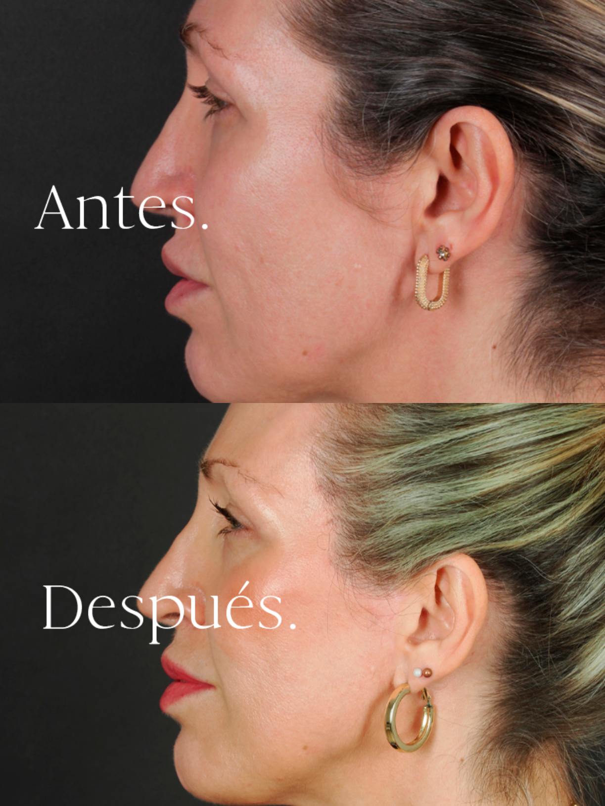 Lifting Facial antes y después