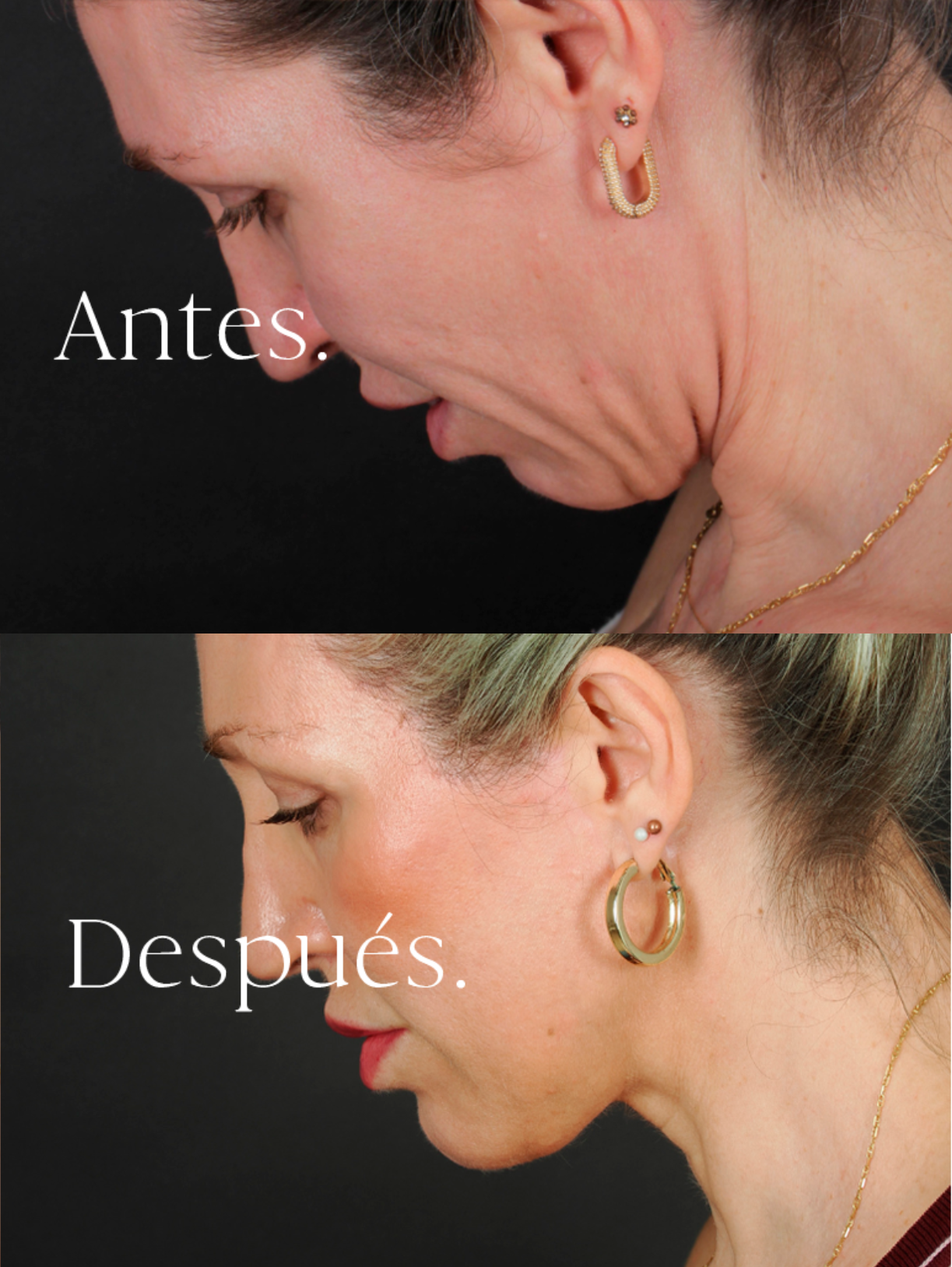Lifting Facial antes y después