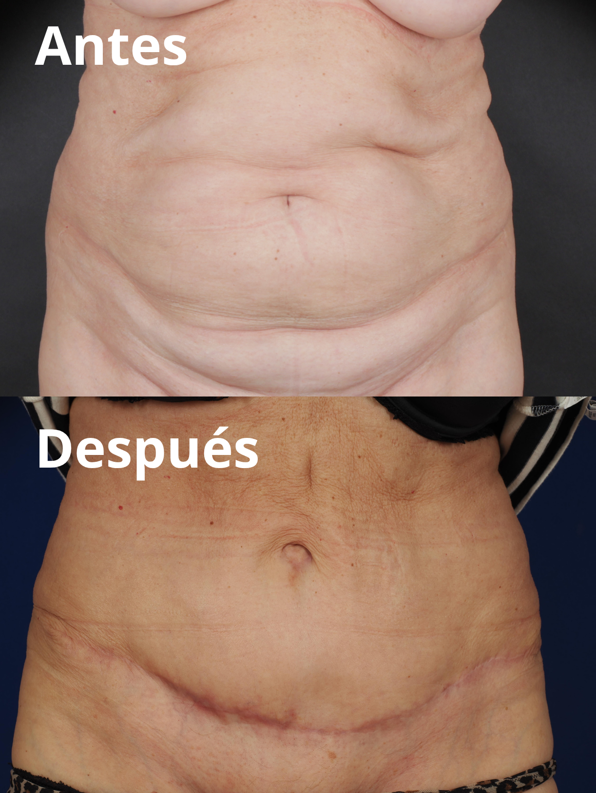 Reducción grasa corporal y abdominal antes y después