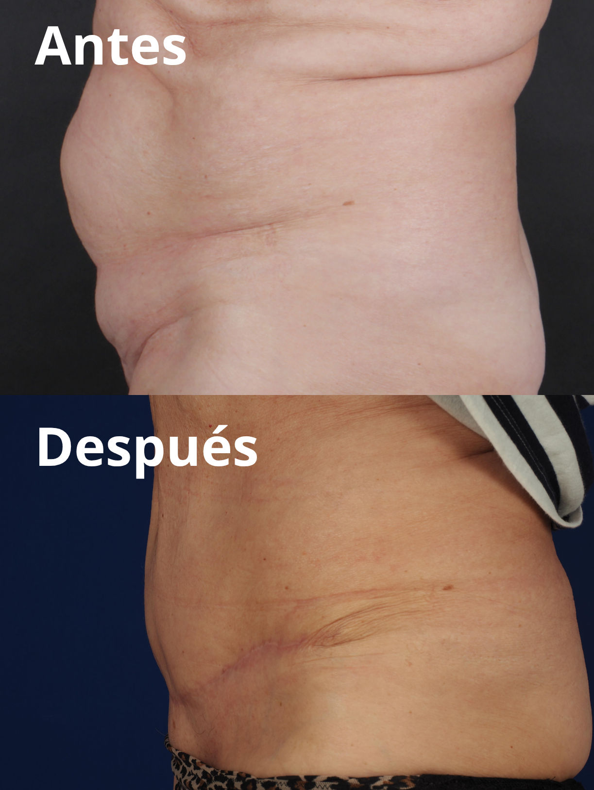 Reducción grasa corporal y abdominal antes y después