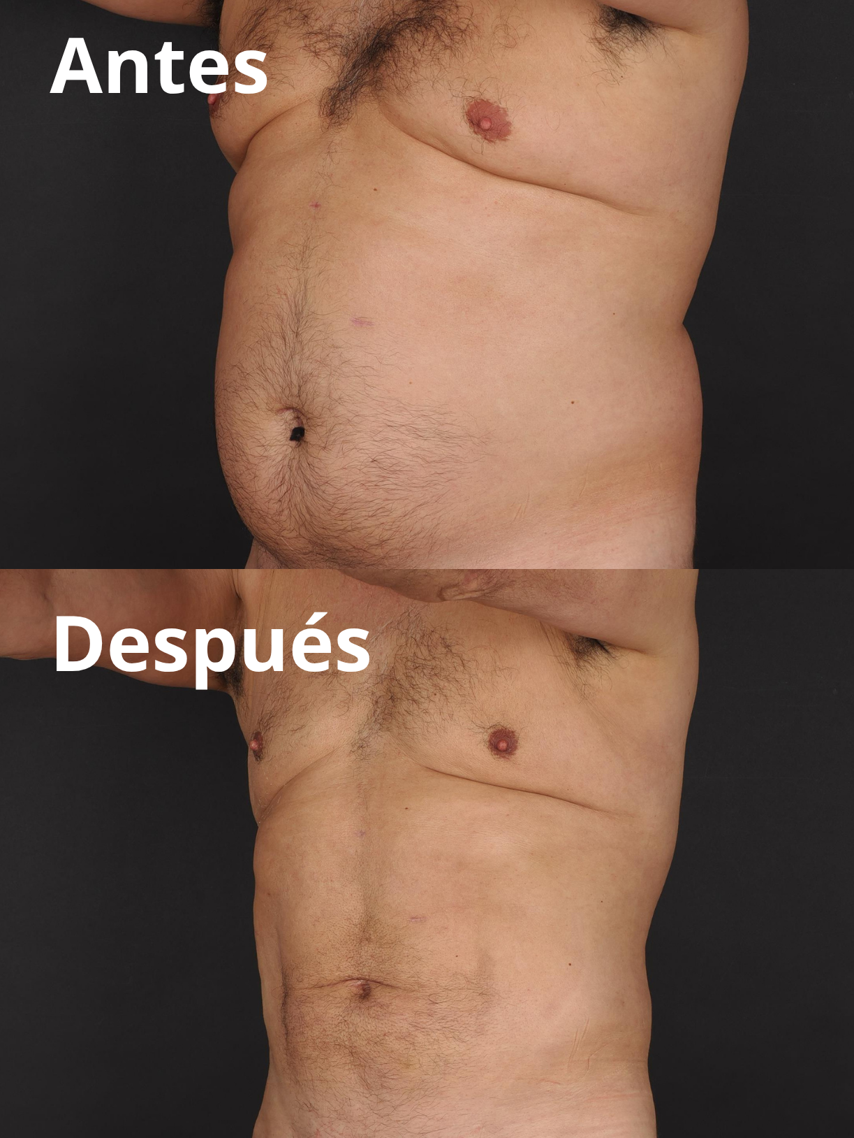 Reducción grasa corporal y abdominal antes y después