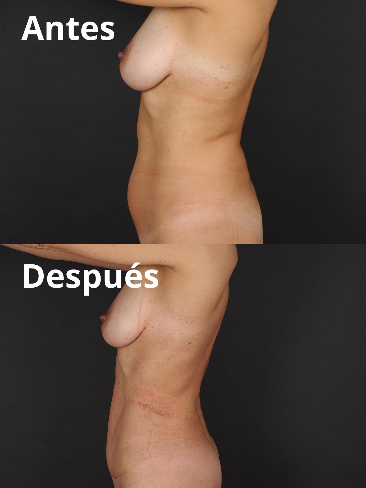 Reducción grasa corporal y abdominal antes y después