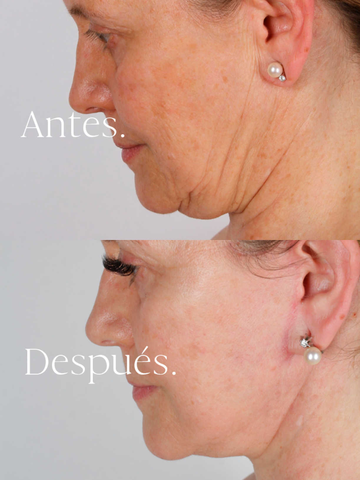 Lifting Facial antes y después