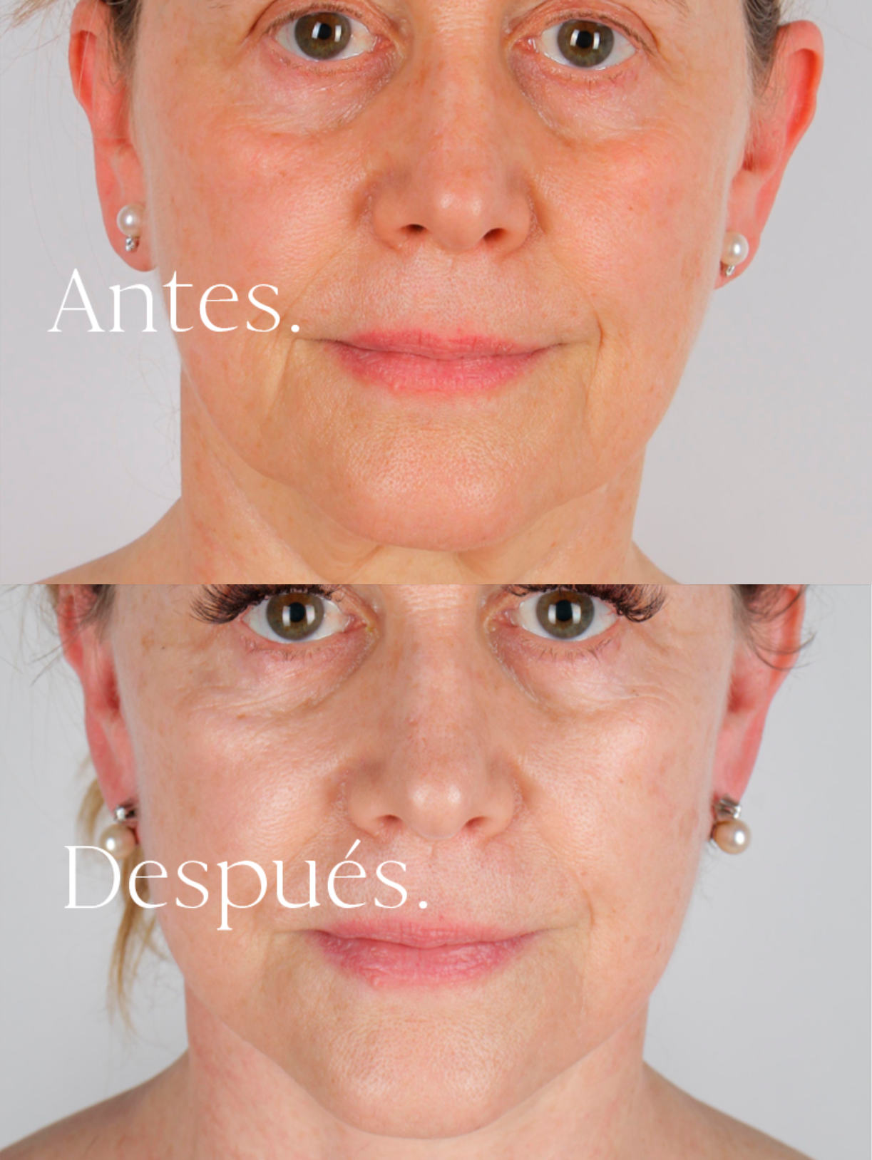 Lifting Facial antes y después