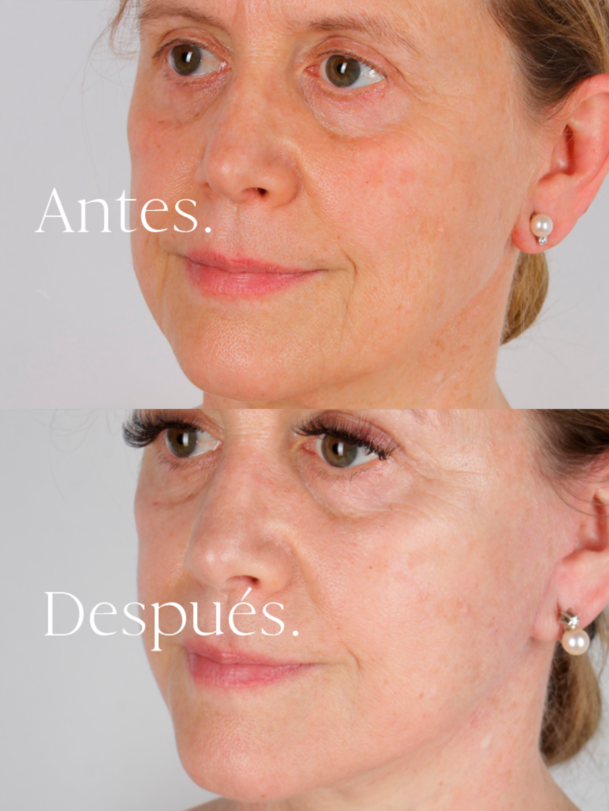Lifting Facial antes y después