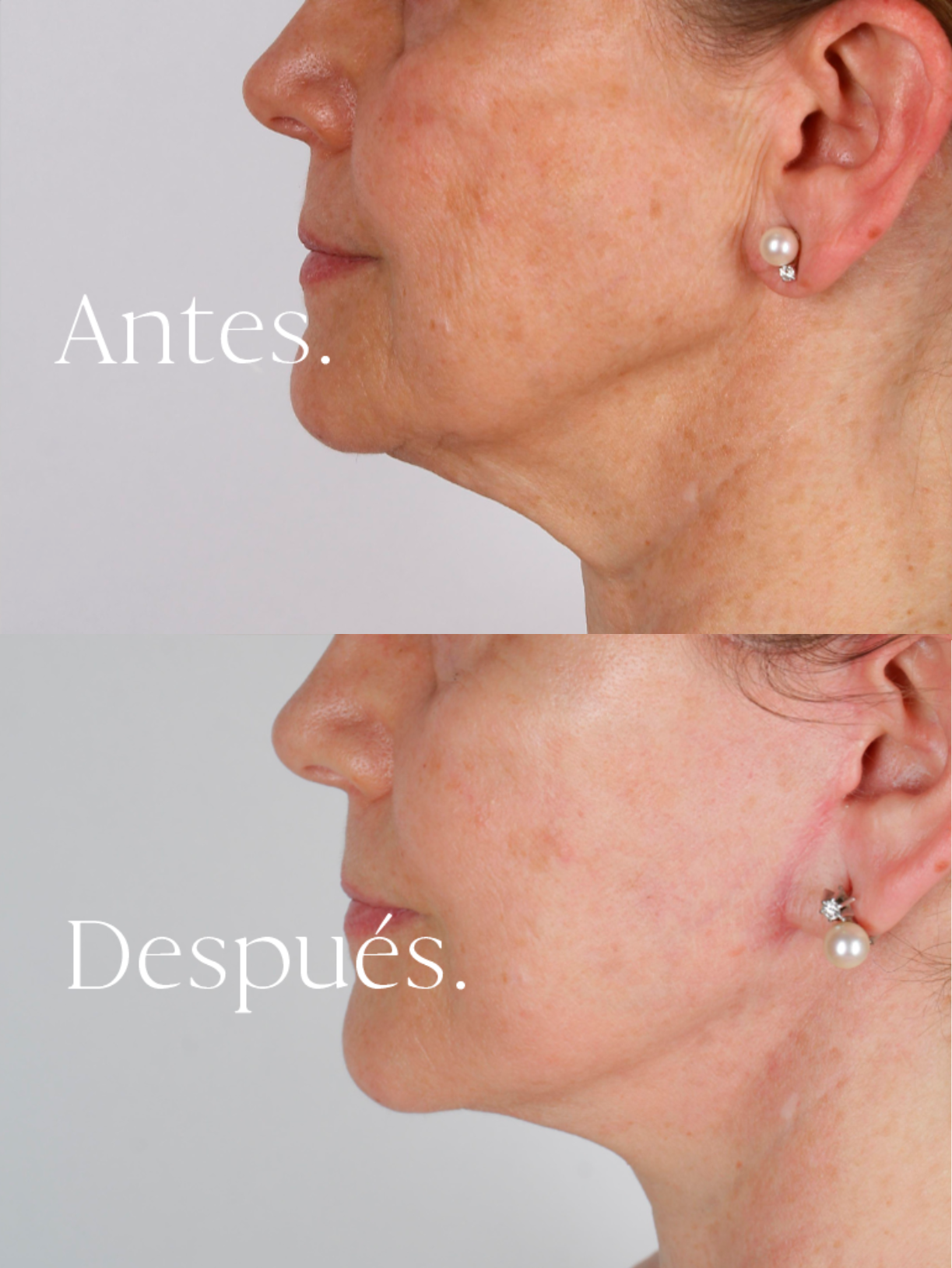 Lifting Facial antes y después