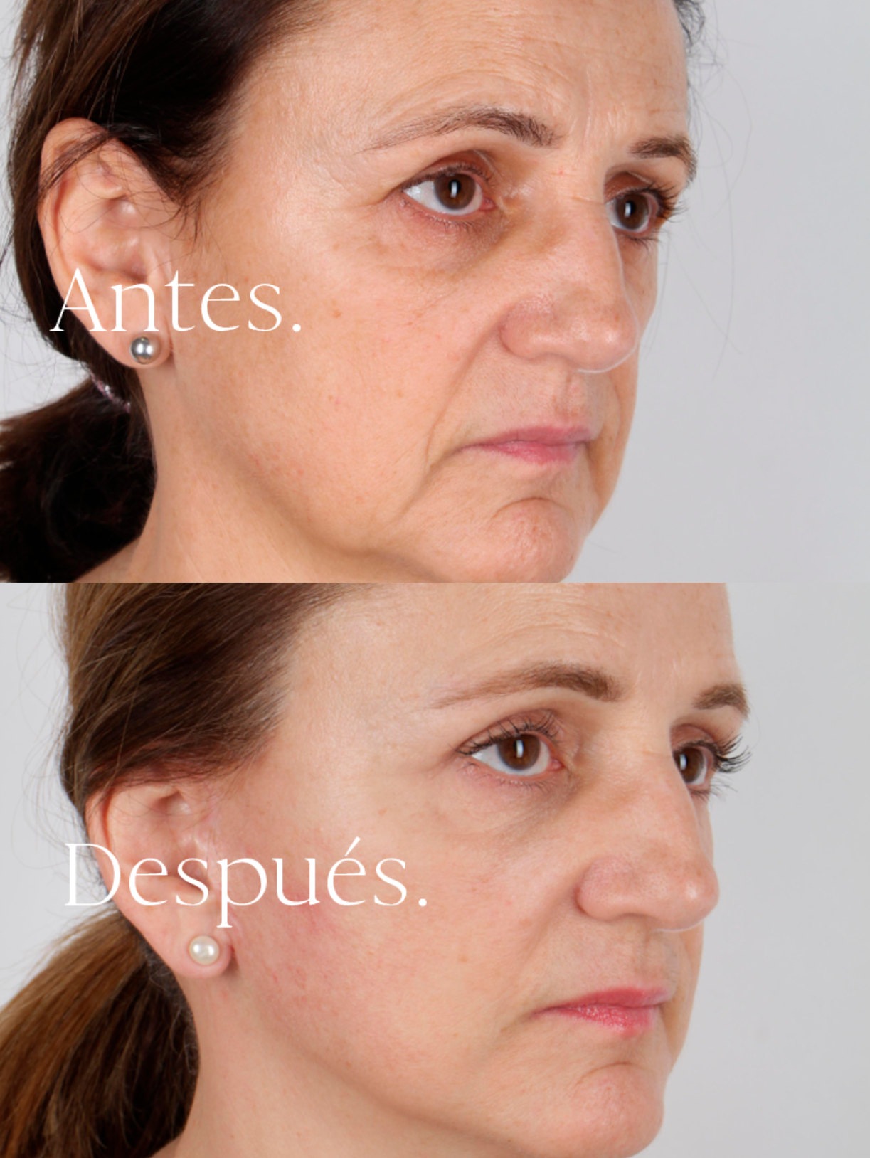 Lifting Facial antes y después