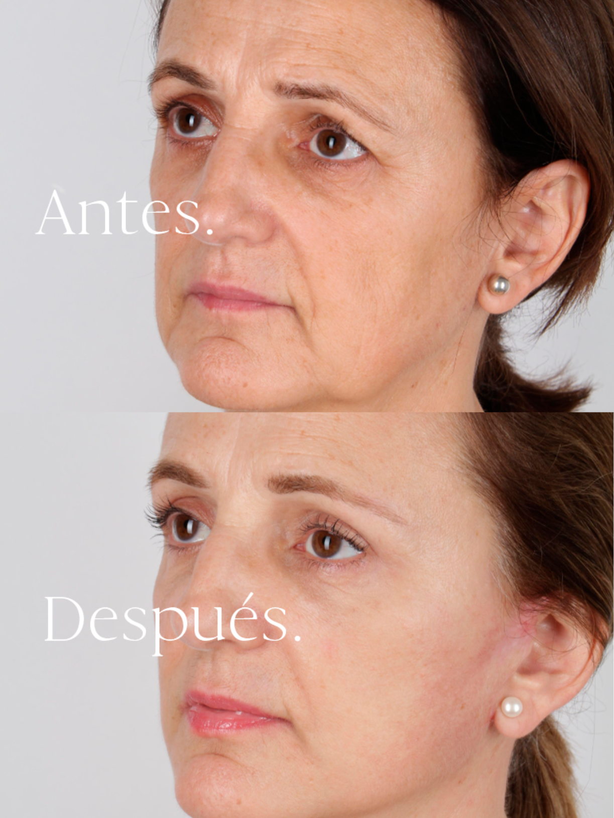 Lifting Facial antes y después
