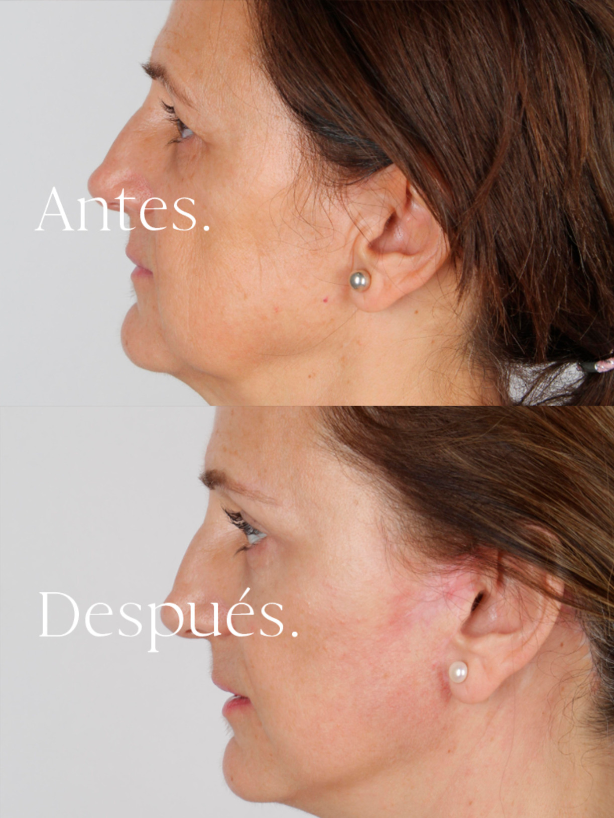Lifting Facial antes y después