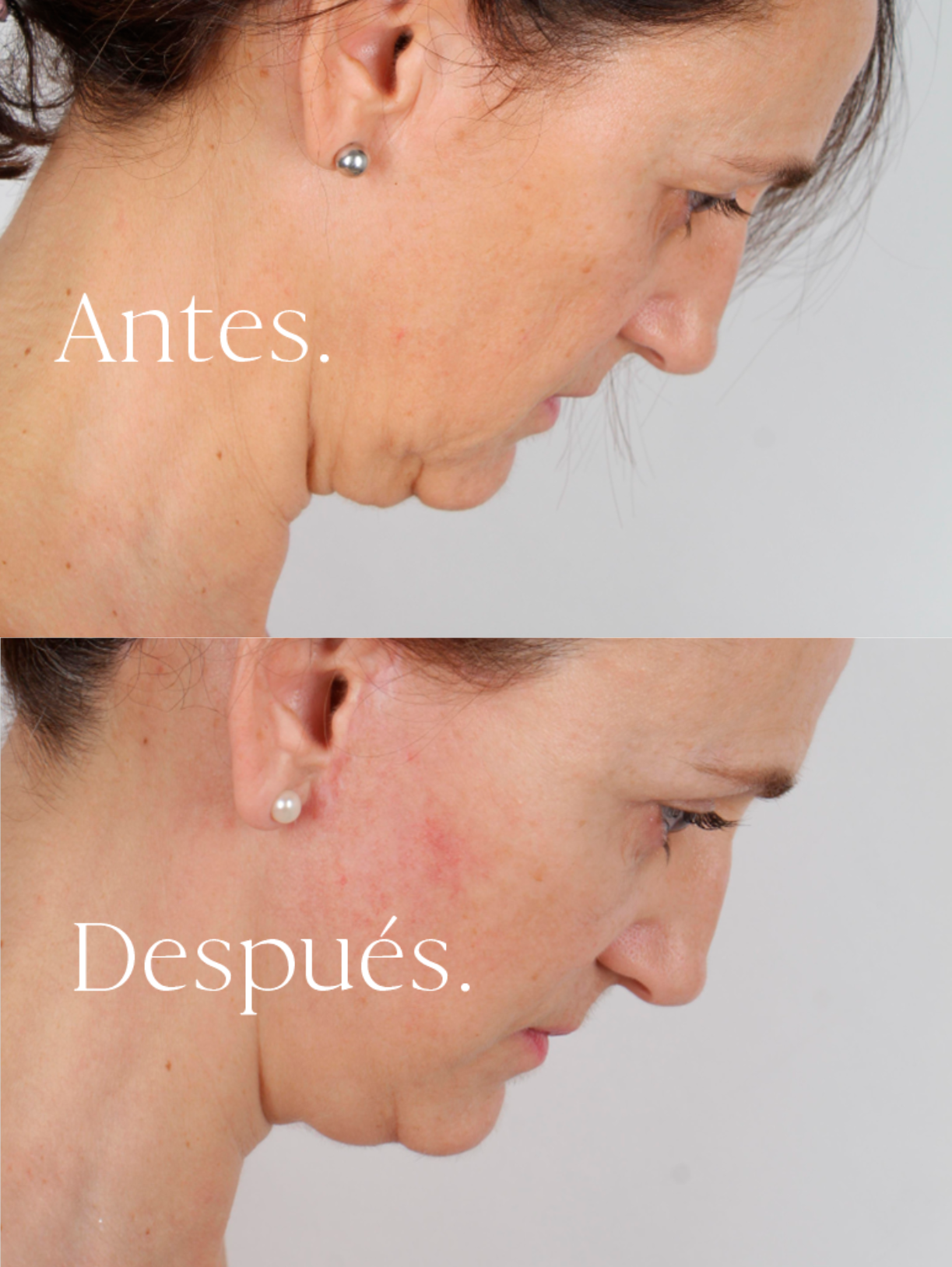 Lifting Facial antes y después