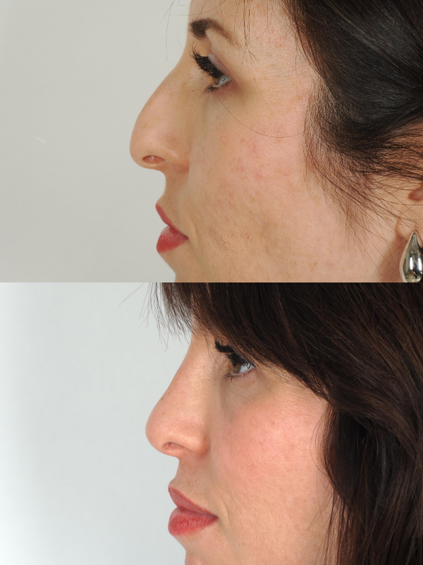 Nas antes y después