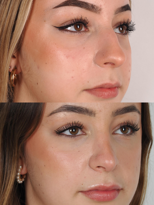 Nas antes y después