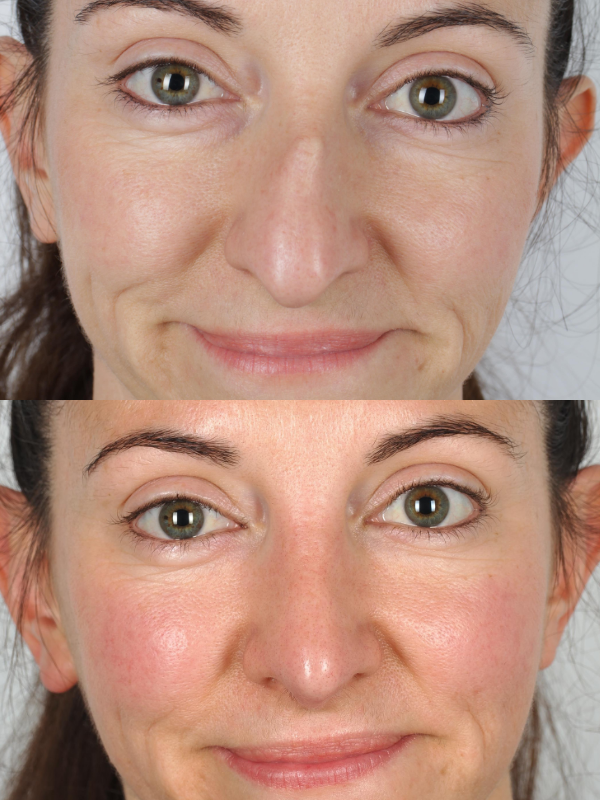 Nas antes y después