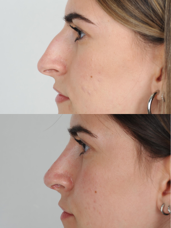 Nas antes y después