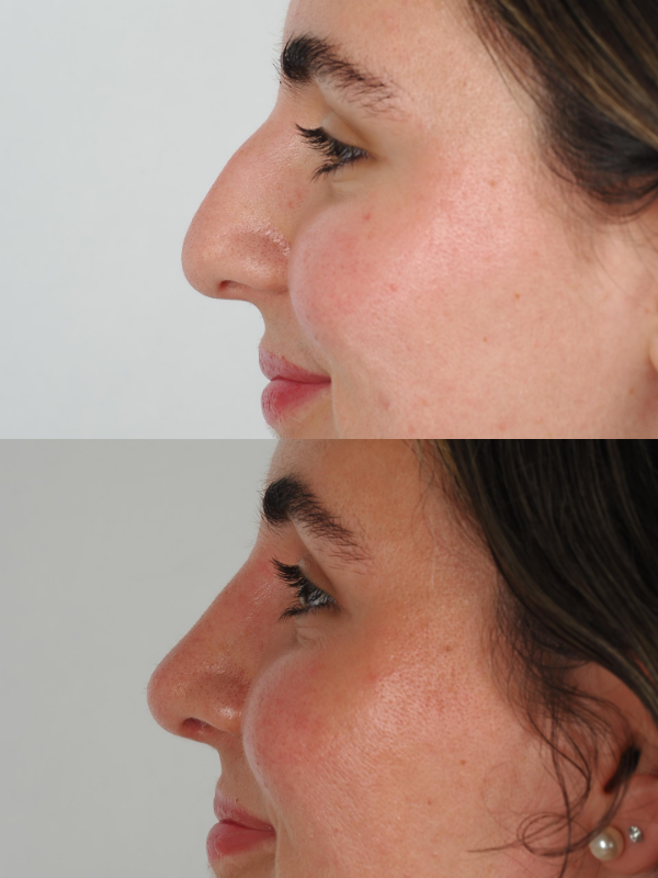 Nas antes y después