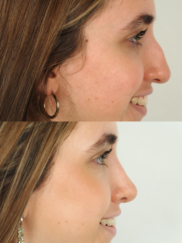 Nas antes y después