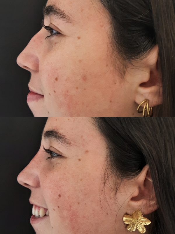 Nas antes y después