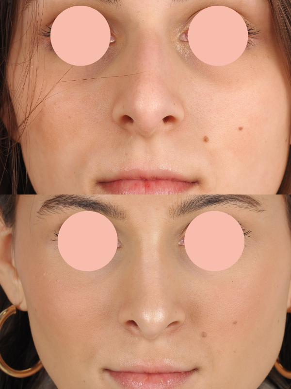 Rinoplastia antes y después