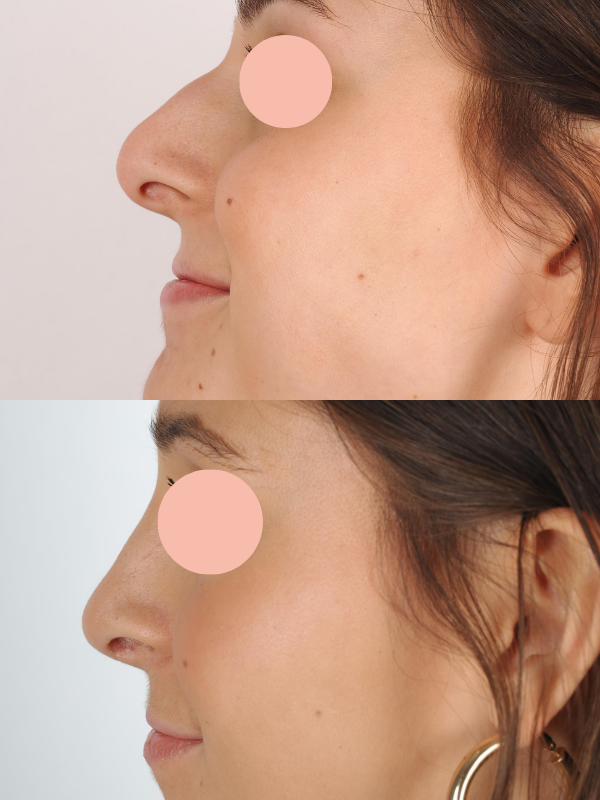 Rinoplastia antes y después