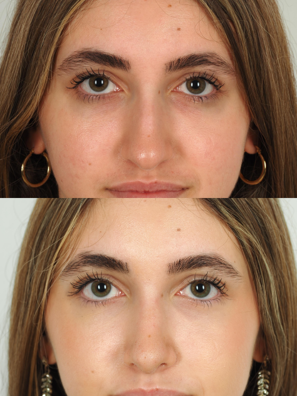 Rinoplastia Ultrasónica antes y después
