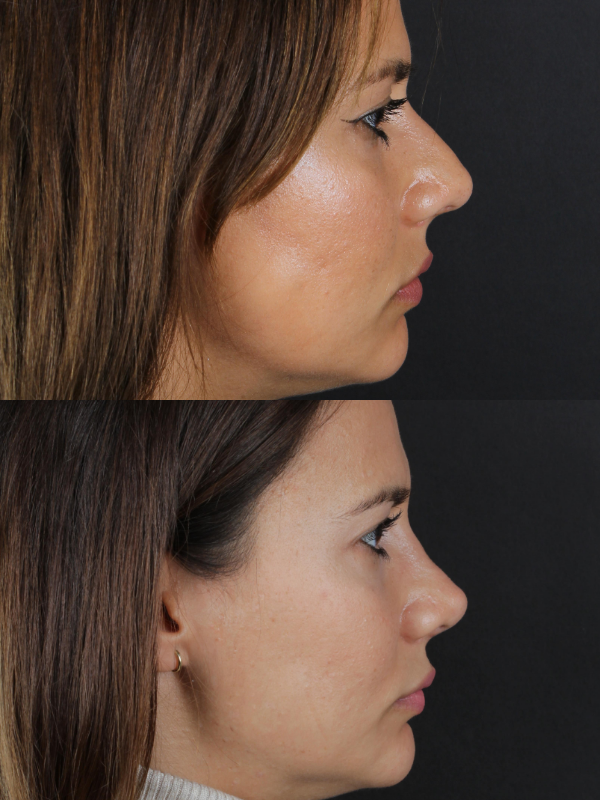 Rinoplastia Ultrasónica antes y después