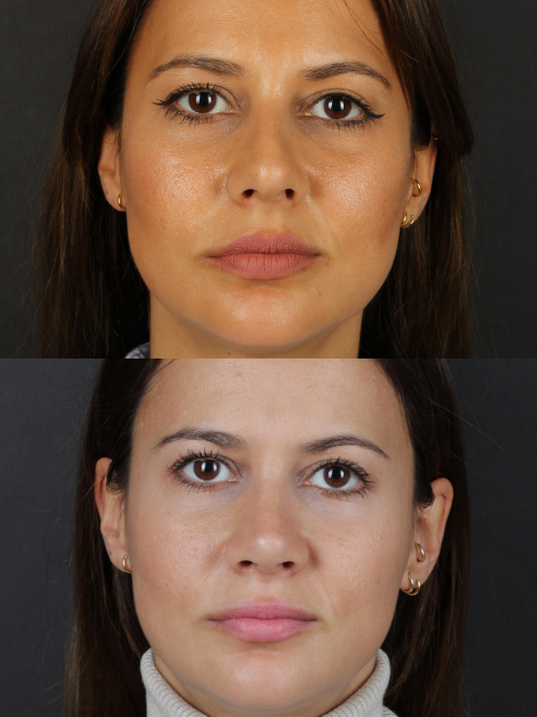 Rinoplastia Ultrasónica antes y después