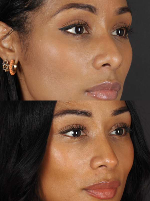 Rinoplastia Ultrasónica antes y después