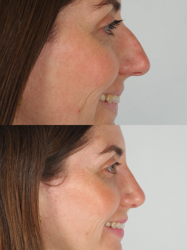 Rinoplastia Ultrasónica antes y después