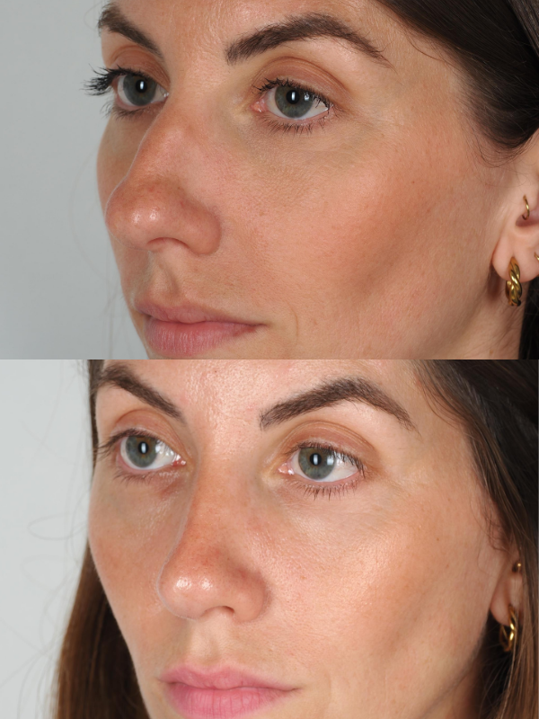 Rinoplastia Ultrasónica antes y después