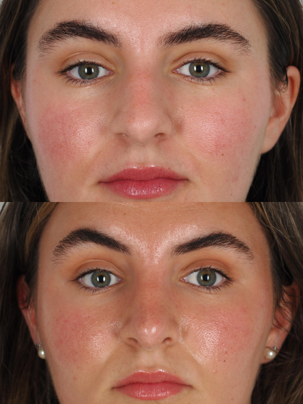 Rinoplastia Ultrasónica antes y después