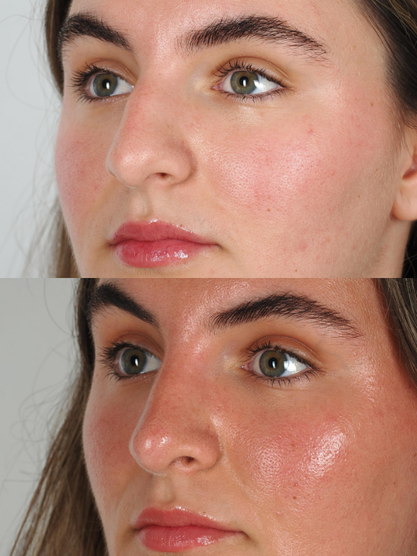 Rinoplastia Ultrasónica antes y después