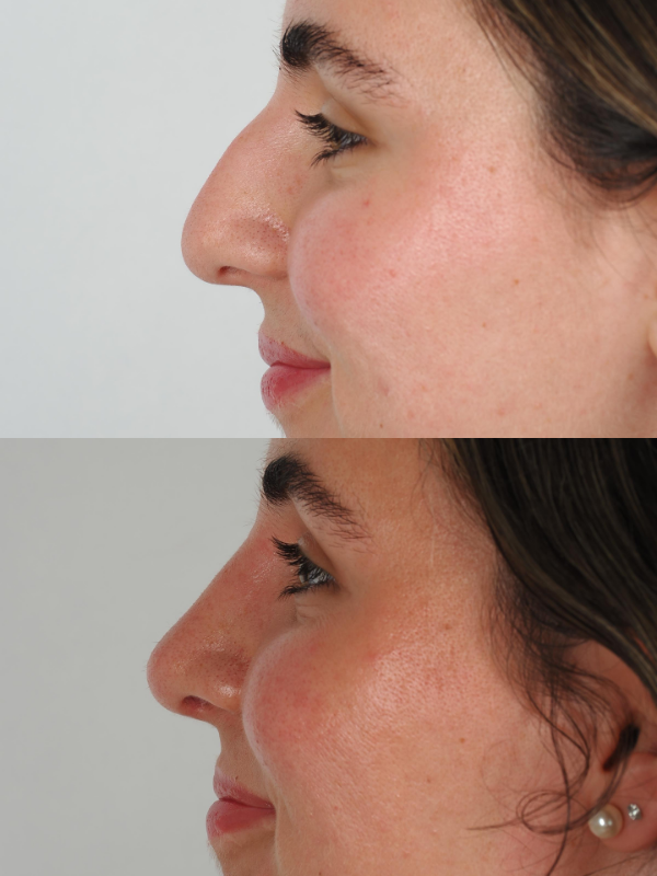 Rinoplastia Ultrasónica antes y después