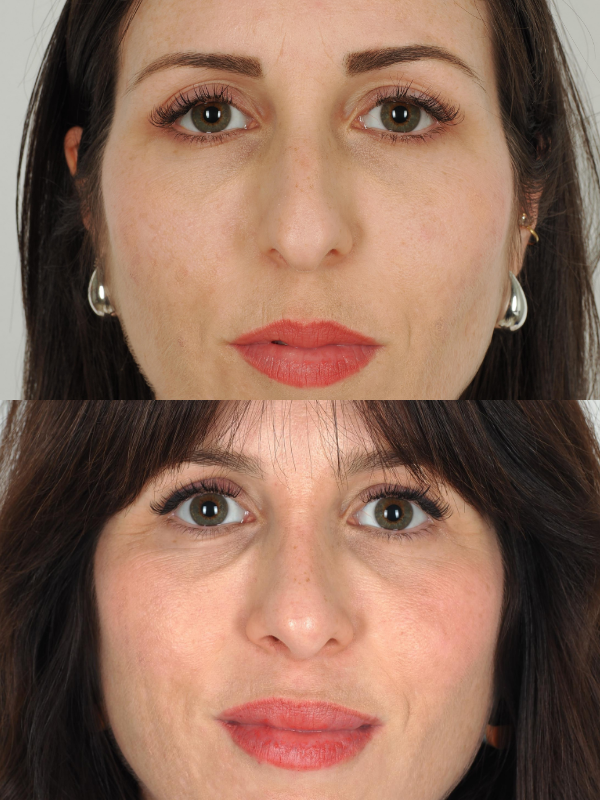 Rinoplastia Ultrasónica antes y después
