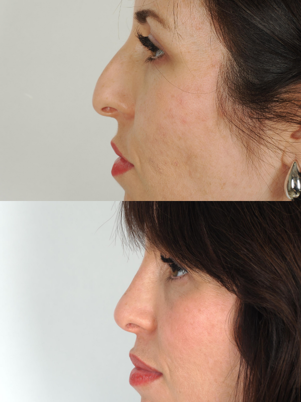 Rinoplastia Ultrasónica antes y después