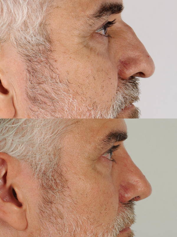 Rinoplastia Ultrasónica antes y después