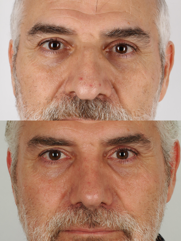 Rinoplastia Ultrasónica antes y después