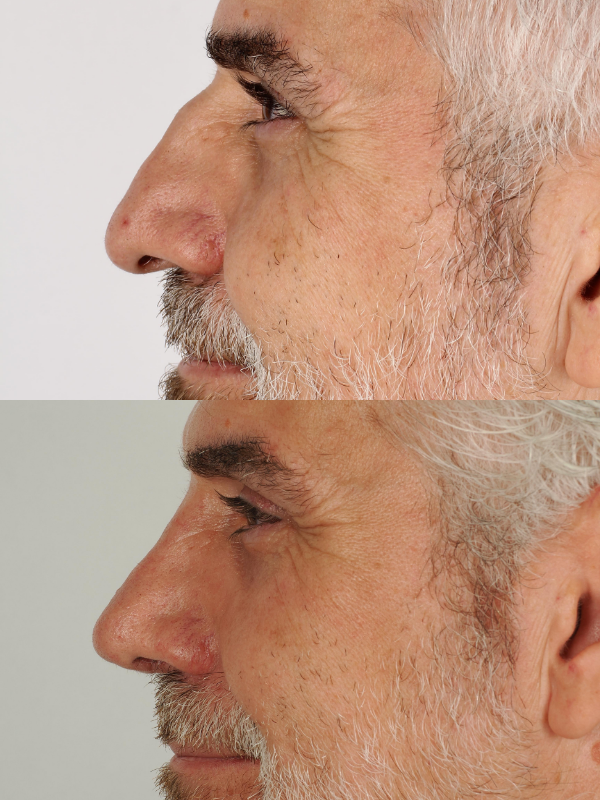Rinoplastia Ultrasónica antes y después