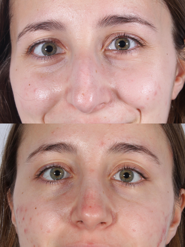 Rinoplastia antes y después