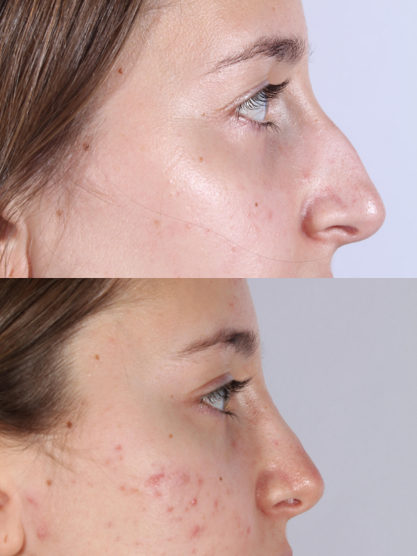 Rinoplastia antes y después