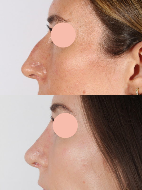 Rinoplastia antes y después