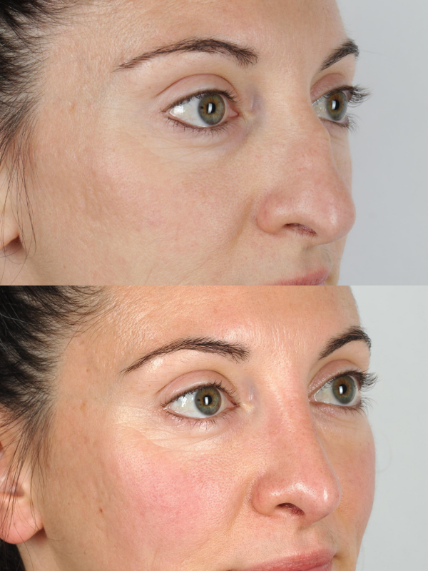 Rinoplastia antes y después